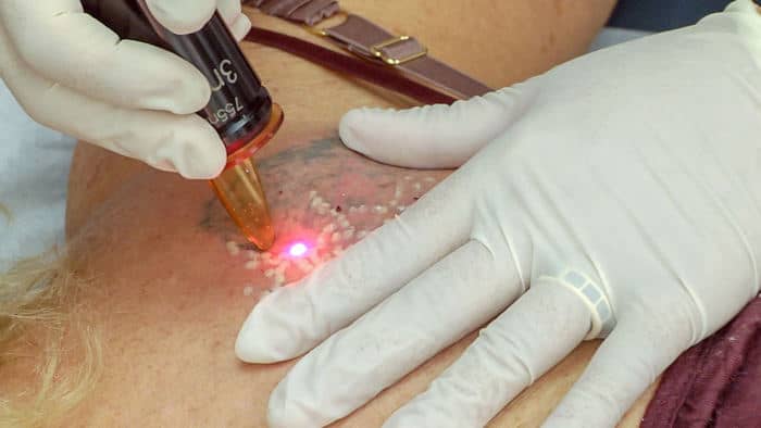 quando non è possibile procedere con il trattamento di rimozione tatuaggi con laser q switched