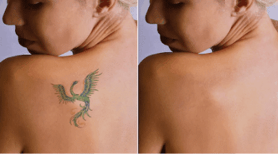 rimozione tatuaggi: trattamento doloroso o indolore?