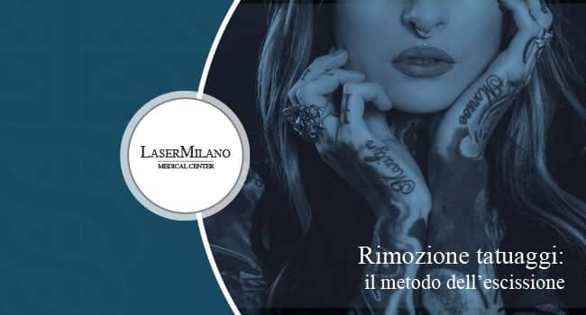 rimozione tatuaggi con escissione o laser? quale trattamento è preferibile?