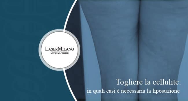 Eliminare la cellulite con un trattamento di liposuzione laser
