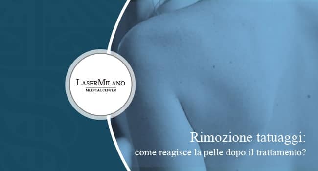 reazione pelle dopo un trattamento di rimozione tatuaggi