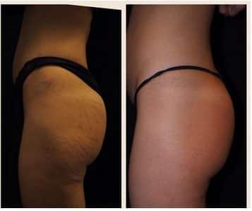 glutei laser