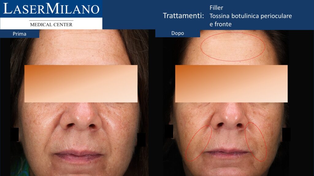 Filler + tossina botulinica perioculare e fronte