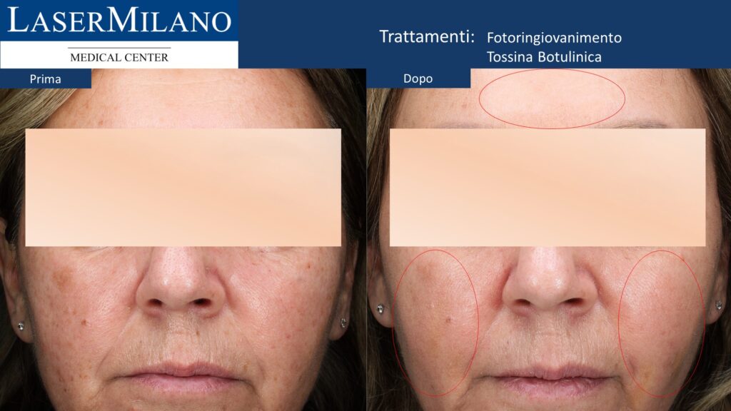 Tossina botulinica e Ringiovanimento Nordlys