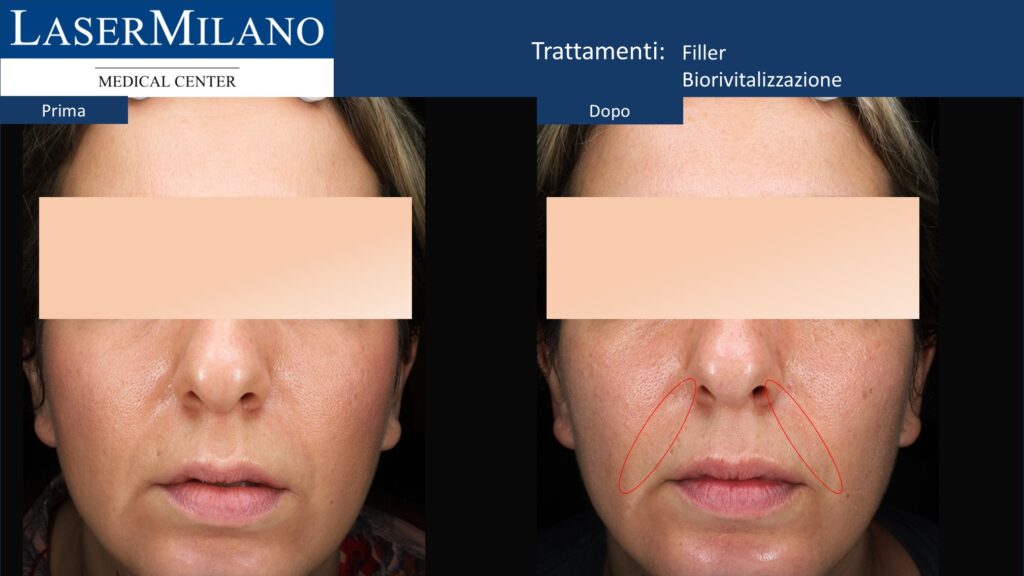 Filler e biorivitalizzazione