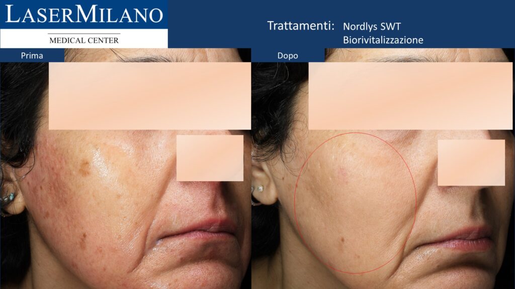 Biorivitalizzazione e Ringiovanimento Nordlys