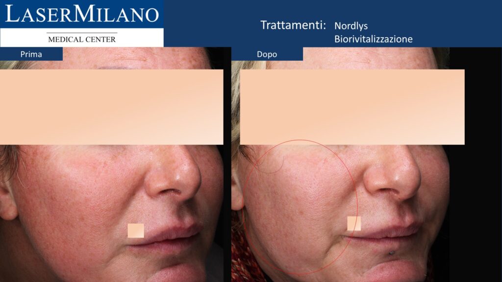 Biorivitalizzazione e Ringiovanimento Nordlys