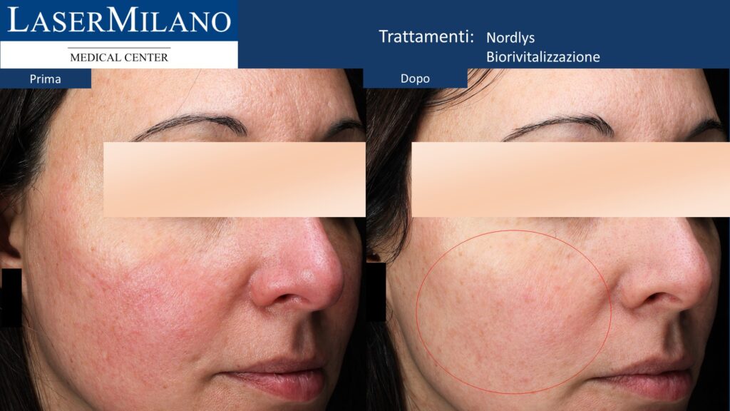 Biorivitalizzazione e Ringiovanimento Nordlys