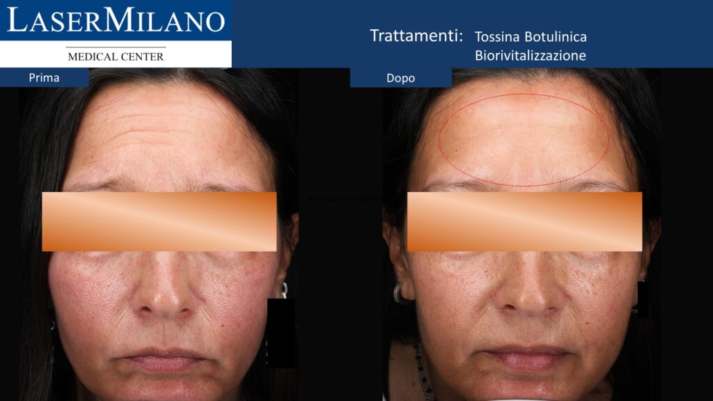 Tossina botulinica e Biorivitalizzazione