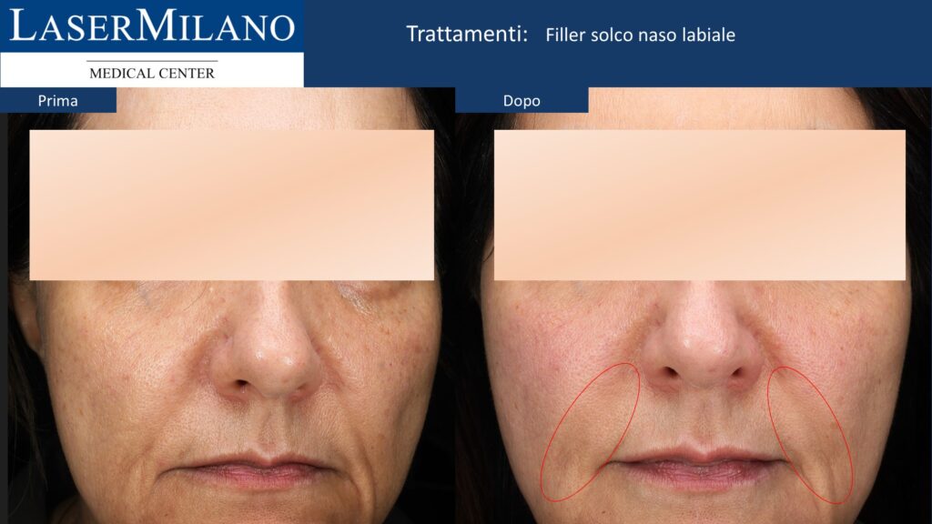 Filler solco naso labiale