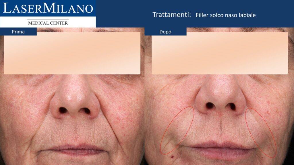 Filler solco naso labiale
