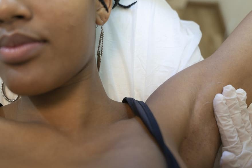 Ragazza che si sta per sottoporre all'epilazione laser | Laser Milano