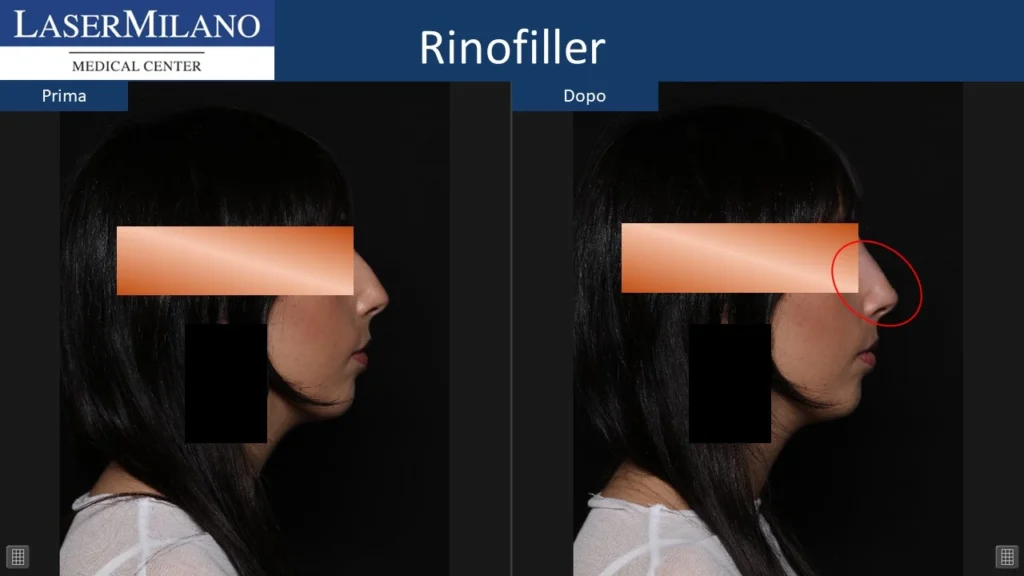 Prima-dopo-rinofiller-2