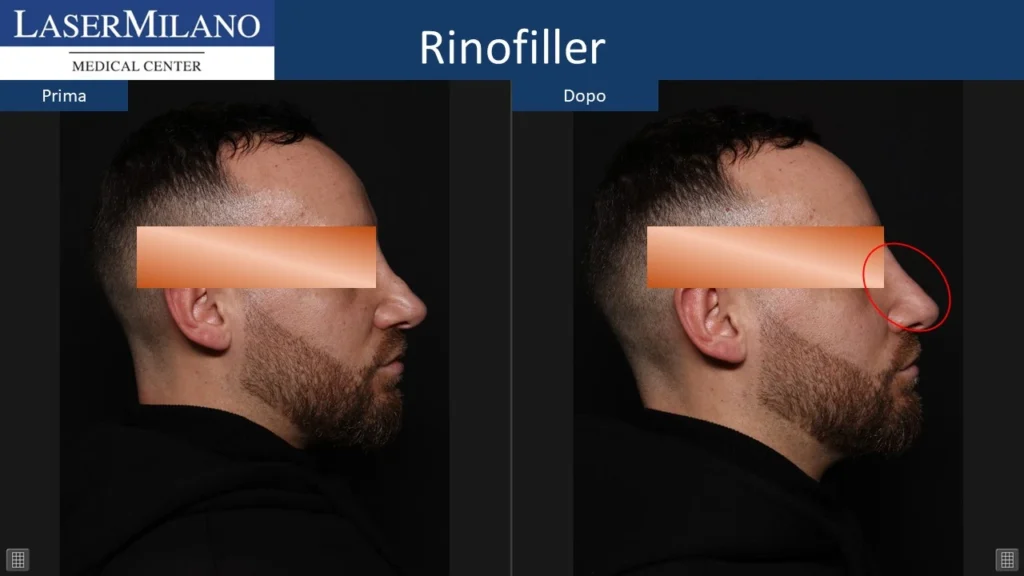 Prima-dopo-rinofiller1