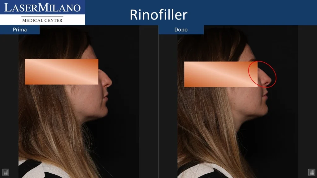 Prima-dopo-rinofiller3