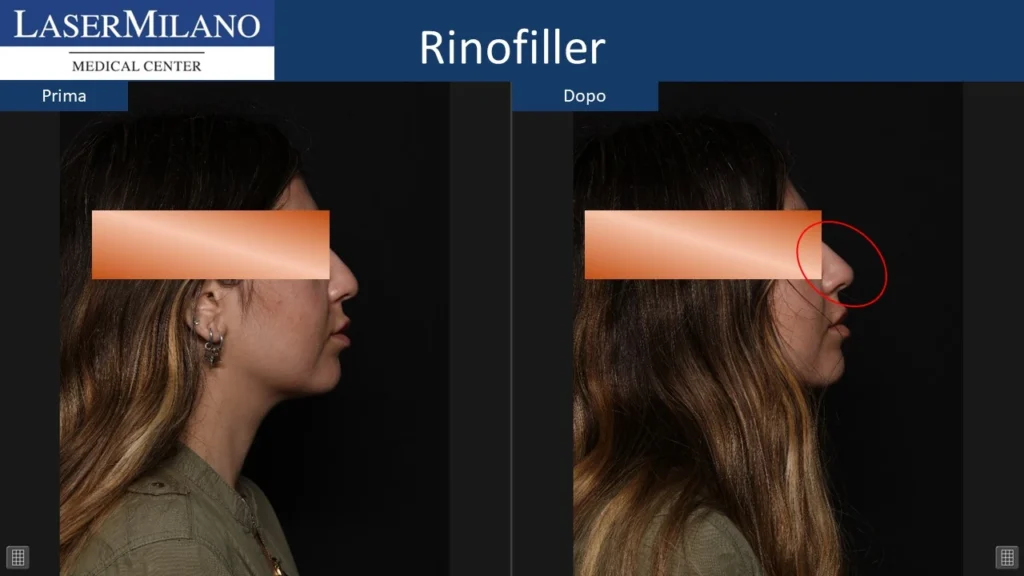 Prima-dopo-rinofiller4