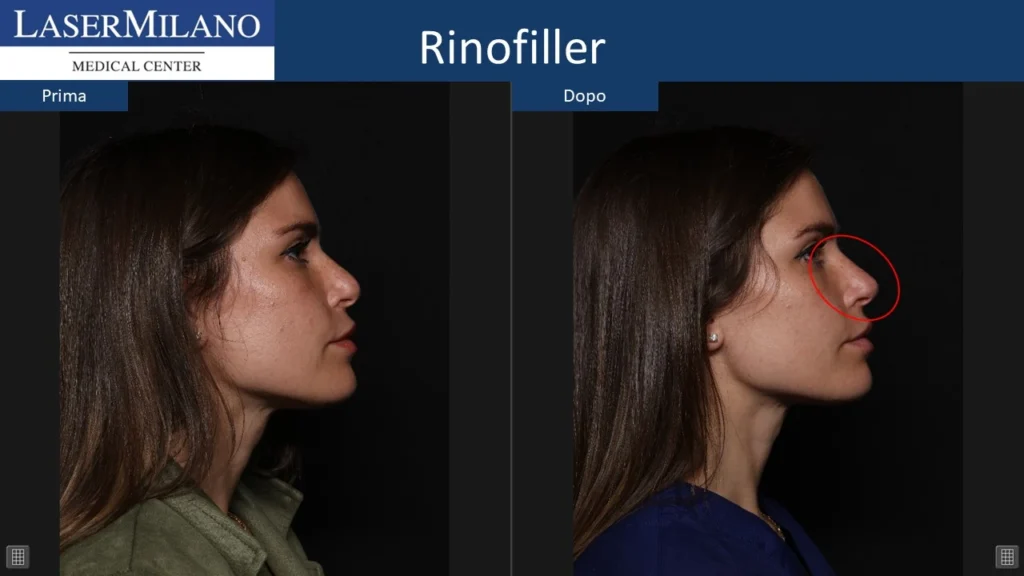 Prima-dopo-rinofiller5