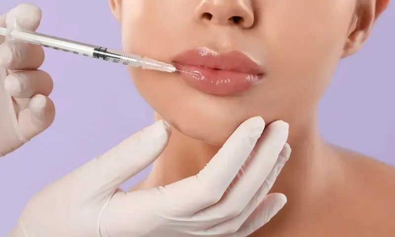 labbra con microiniezione | Laser Milano