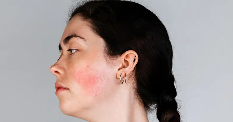 Donna di profilo che ha dei segni di capillari nella guancia | Laser Milano