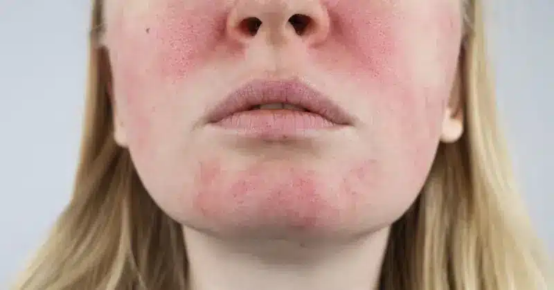rossore nel viso di una donna | Laser Milano