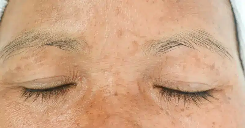 macchie sul visto di una persona nel particolare | Laser Milano