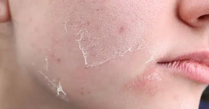 Particolare della guancia con pelle che si sta esfoliando | Laser Milano