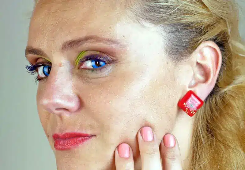Donna bionda di profilo, con poche rughe | LaserMilano