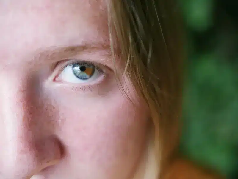 Donna bionda con occhi azzurri e fenotipo chiaro | LaserMilano