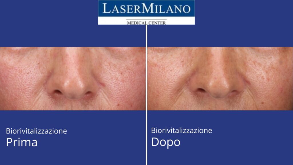 Biorivitalizzazione foto prima e dopo