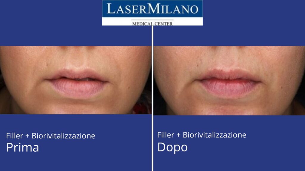 Biorivitalizzazione+Filler foto prima e dopo