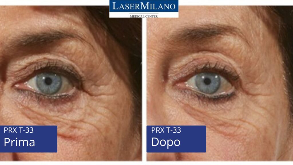 PRX T-33 foto prima e dopo