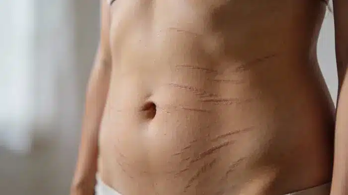 Smagliature in gravidanza: immagine di esempio | LaserMilano