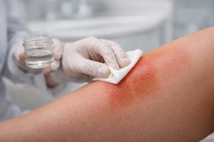 Applicazione di peeling chimico medicale per correggere macchie epidermiche da IPL | Laser Milano