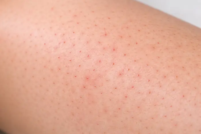 Edema perifollicolare dopo luce pulsata con rossore puntiforme fisiologico | Laser Milano