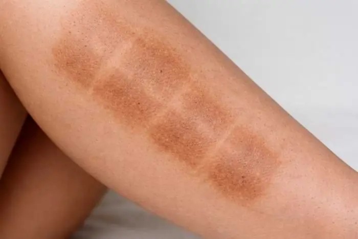 Hai notato delle macchie da luce pulsata? Rimedi e soluzioni per correggerle | Laser Milano