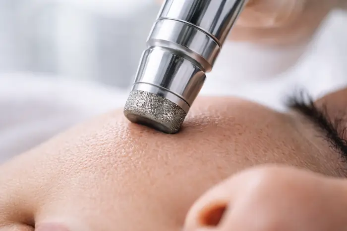 Dettaglio manipolo a punta di diamante per microdermoabrasione viso con tecnologia vacuum professionale. | Laser Milano