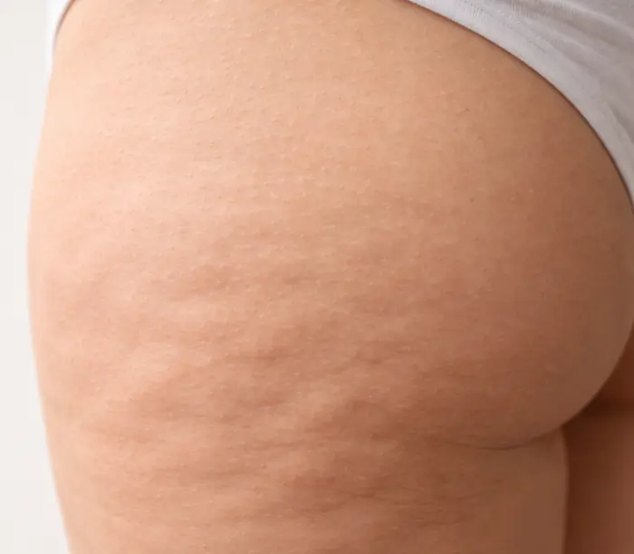 Macro della pelle con lieve effetto buccia d’arancia, esempio realistico di cellulite in fase iniziale su coscia femminile. | Laser Milano