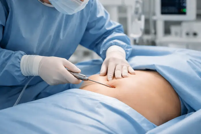 Procedura di liposuzione addominale eseguita in sala operatoria sterile | Laser Milano
