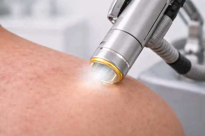 Dettaglio del manipolo laser medicale con sistema di raffreddamento per epilazione alla schiena. | Laser Milano