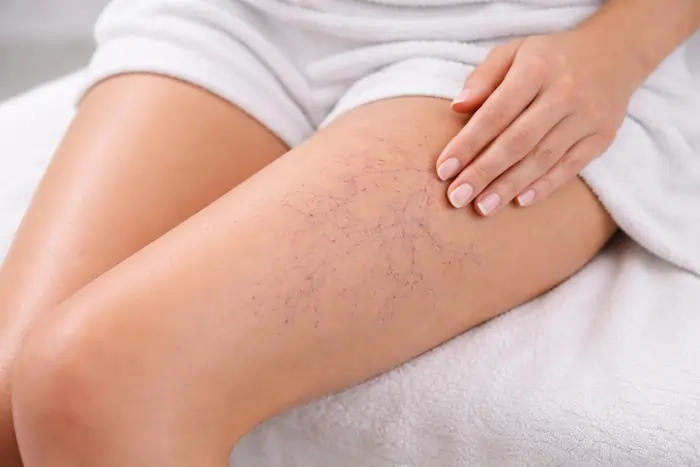 Gambe con capillari visibili | Laser Milano