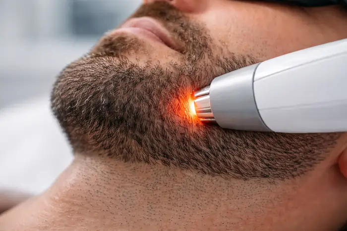Epilazione laser della barba: come funziona il trattamento che riduce i peli e migliora la qualità della pelle del viso | Laser Milano
