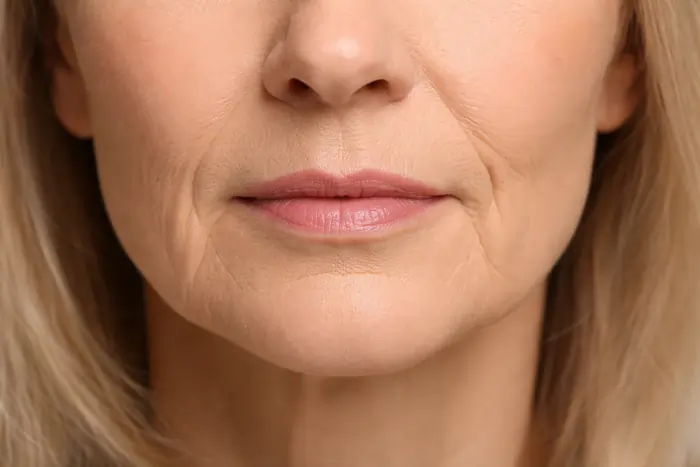 Rughe della marionetta: come il filler le corregge in modo naturale e duraturo | Laser Milano
