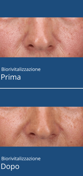 Biorivitalizzazione_carosello