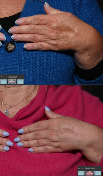 Mani-prima-e-dopo-vert-s