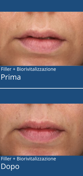 biorivitalizzazione-piu-filler_carosello